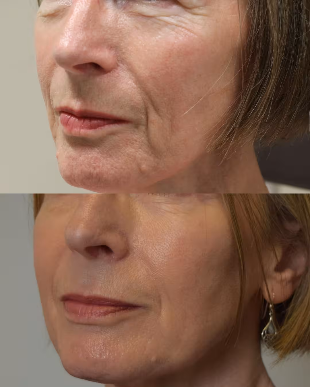 CO2 Laser Resurfacing 1