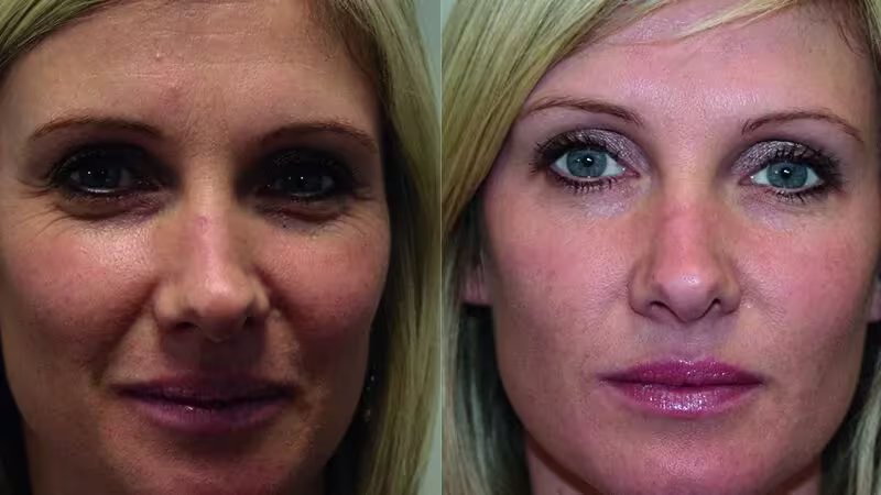 Botox®