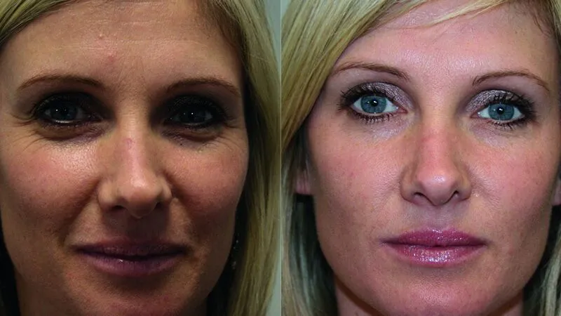 Botox 1