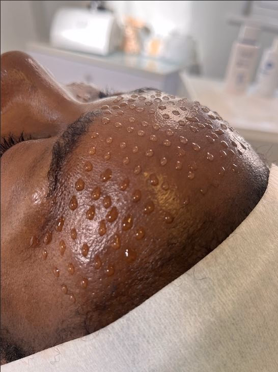 Mesotherapy