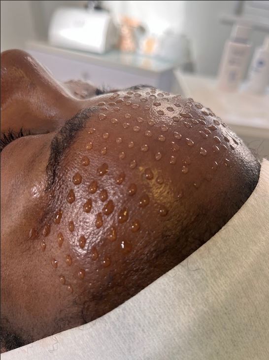 Mesotherapy 1
